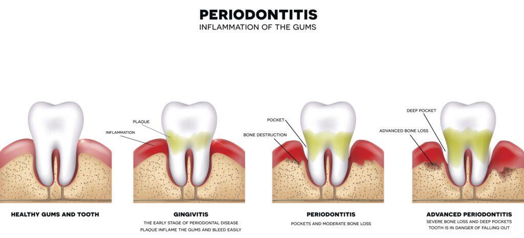 arestin treatment for periodontitis in san antonio tx